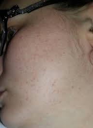 Therefore, red dots are formed under your eyes that are formed in clusters and characterized by their flat and red color. Non Itchy Flat Red Dots On Face Pic Babycenter