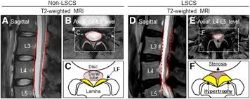 As we age, the ligament loses elastin, and this allows the ligament to. Macrophage Infiltration Is A Causative Factor For Ligamentum Flavum Hypertrophy Through The Activation Of Collagen Production In Fibroblasts The American Journal Of Pathology