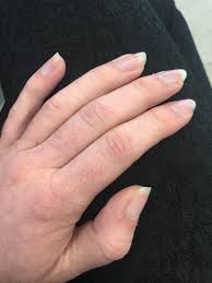 We did not find results for: Anyone Know What Causes This Skin Peeling Around The Nail Bed Excuse Red Hands Have Raynauds Nails