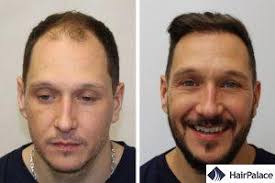 In una sola sessione di circa 6,5 ore è possibile impiantare ad alta . Trapianto Di Capelli A Parigi Prezzi E Servizi Hairpalace