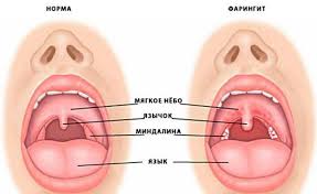 Image result for laringitis