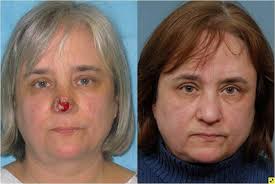 If you have skin cancer, it is important to know which type you have because it affects your treatment options and your outlook (prognosis). Mohs Surgery And Skin Cancer Johns Hopkins Facial Plastic And Reconstructive Surgery