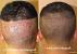 Fue Donor Area After 2 Weeks