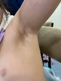 Image result for Diffuse Hyperpigmentation