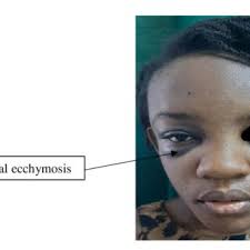 Measurement through coronal