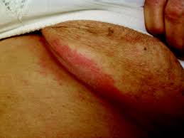 This rubbing can cause a breakdown in the top layers of the skin, causing inflammation. Resistant Candidal Intertrigo Could Inverse Psoriasis Be The True Culprit American Board Of Family Medicine