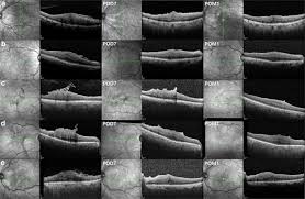 If your retina has detached, you'll need surgery to repair it, preferably within days of a diagnosis. Bare Retinal Nerve Fiber Layer And Internal Limiting Membrane Tear Associated With Epiretinal Membrane Oct Findings And Visual Outcomes Springerlink