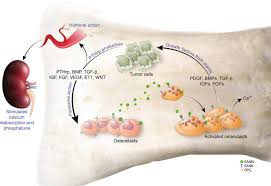 Image result for Hypercalcemia