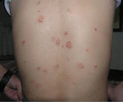 It's possible that the rash could be something other than pityriasis rosea. Pityriasis Rosea Causes Rash Herald Patch Stages Treatment