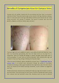 Benefits Of Compression Hose For Varicose Veins