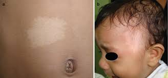 We did not find results for: Hypopigmentary Disorders Springerlink