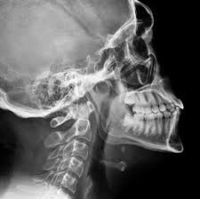 Image result for Sialolithiasis