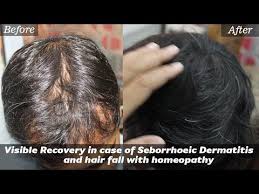 Seborrheic dermatitis is known as cradle cap in infants. Visible Recovery In Case Of Seborrhoeic Dermatitis And Hair Fall With Homeopathy Case Study