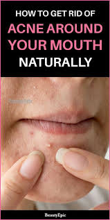 How To Get Rid Of Acne Around Mouth How To Get Rid Of Acne Acne Around The Mouth Skin Care Pimples