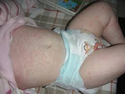 Baby Rash Pictures Causes Treatments Baby Rash Baby Pictures Treatment