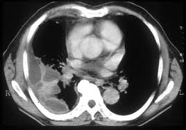 To facilitate drainage of loculated hemorrhagic or fibrinous nonhemorrhagic pleural fluid collections. Pleural Effusion Postgraduate Medical Journal