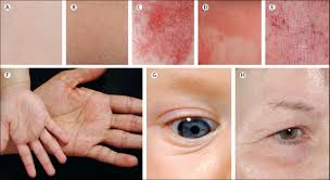 Image result for Atopic eczema atopic dermatitis