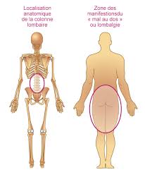 Quand tu mens bébé c'est pas toi non c'est un tout sapé pour 10 000, je sers, j'ai des potes au trou. Comment Se Manifeste Une Lombalgie Lomboradiculalgie Commune La Rhumatologie Pour Tous