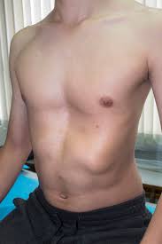 An Extensive Guide To Pectus Excavatum Find Expert Advice