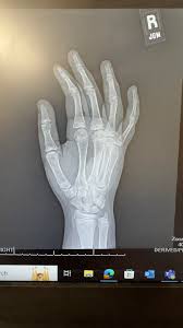 Image result for Hand Growth Plates