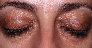 Do You Happen To Have These Yellowish Firm Rounded Bumps Around Your Eyes Well They Are Called Syri Dry Skin Around Eyes Bumps Under Eyes Pimples On Forehead
