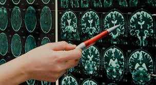 Skader i hjernen er spredt og symptomer og utfall varierer ut fra hvor skaden sitter. Alzheimers Sygdom Og Demens Om Symptomer Arvelighed Og Behandling