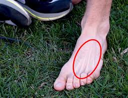 3rd metatarsal fractures rarely occur in isolation. What Causes Metatarsal Stress Fracture In Runners And How Can You Prevent It Research Backed Solutions Running Writings