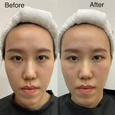 Deusaderm Collagen
