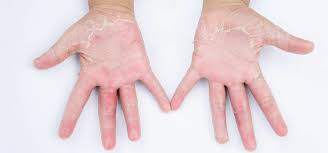 Image result for dermatitis contacta allergica