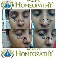 It can typically be managed with moisturizing creams and home care. Dr Ajays Homeopathy Homeopathy For Xerosis Of The Skin Dry Skin Homeopathy Dry Skin Remedies Celebrity Skin Care