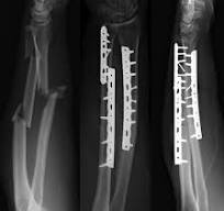 Forearm Fractures | Musculoskeletal Key