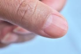 Gespaltene Fingernagel Ursachen Und Behandlung Von Bruchigen Nageln