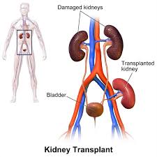 Posterior to the rib cage b. Transplant Surgery Kidney Transplant