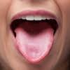 Problemas Linguales Medlineplus Enciclopedia Medica