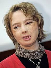 What Happened to Laura Kightlinger's Face????!