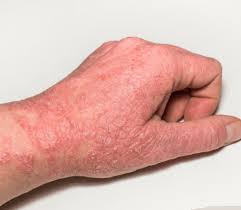Image result for Hand Dermatitis