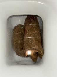 Image result for blood in stool human poop