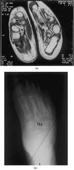 However, in these cases, the foot is usually more deformed. References In Magnetic Resonance Imaging In Follow Up Of Treated Clubfoot During Childhood European Journal Of Radiology