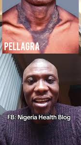 Pellagra