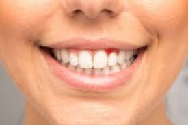 This involves regular brushing with fluoride toothpaste, flossing, and having frequent dental checkups. The Importance Of Having Healthy Gums