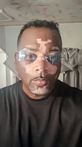 The Vitiligo & Albinism Network