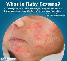 The eczema affects babies anywhere on their body, and mostly on their arms, legs, and cheeks. What Is Baby Eczema Causes Symptoms Treatment Home Remedies