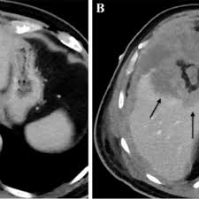 Maybe you would like to learn more about one of these? 55 Year Old Man With Malignant Peritoneal Mesothelioma Of Sarcomatoid Download Scientific Diagram