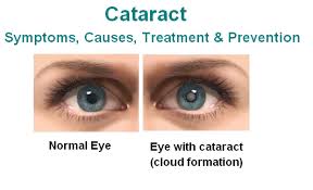 Cataract Surgery Marano Eye Care Cataract Symptoms Cataract Surgery Cataract
