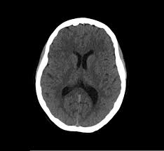 Image result for CT Head