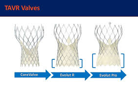 Transcatheter Aortic Valve Replacement Tavr For Bicuspid