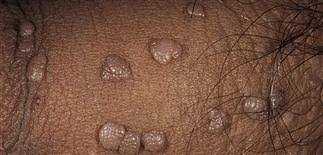 Image result for genital warts