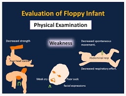 Image result for Floppy Infant