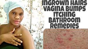 But on the vulva, ingrown hair bumps are often mistaken for something else (think: How To Stop Ingrown Hairs Itching Vagin L Bumps From Shaving Waxing Shaving Tips For Women Youtube