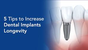 5 Tips to Increase Dental Implants Longevity - Vistadent